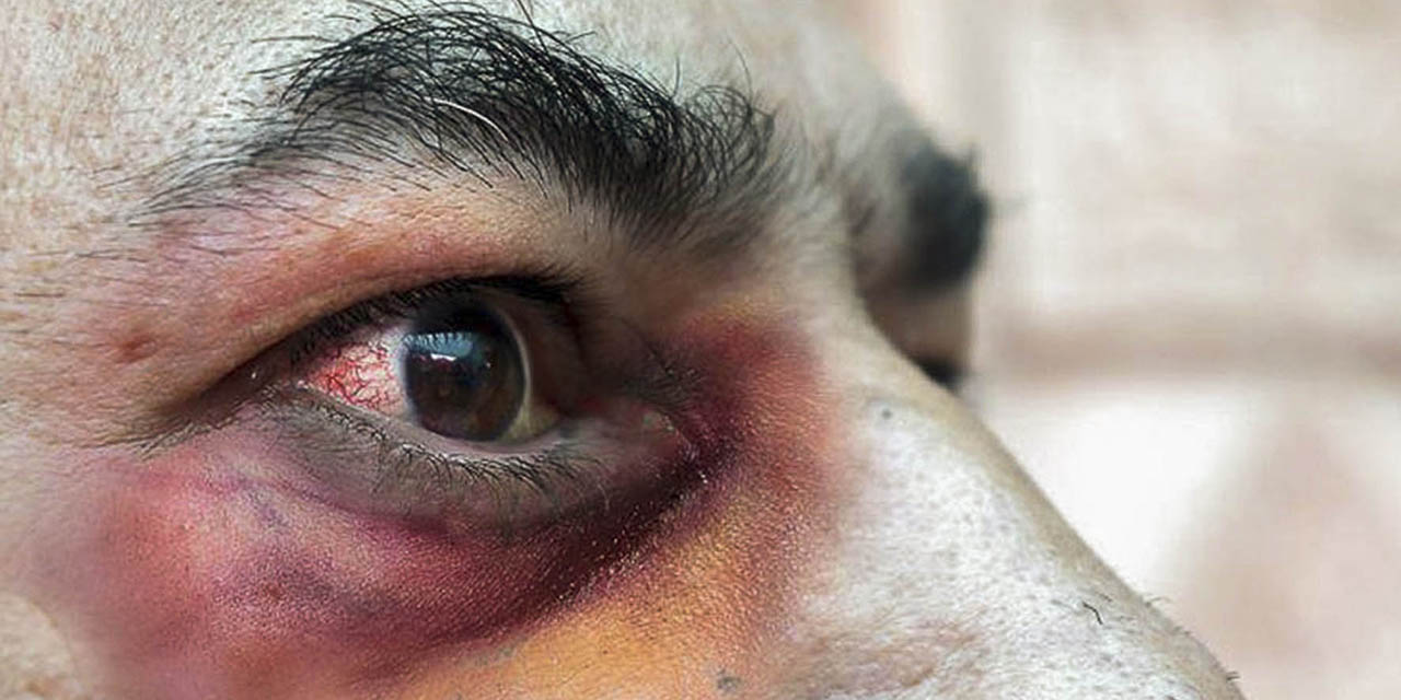 Confirman sólo un caso de mucormicosis en HRAEO