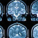 Crean Inteligencia Artificial capaza de diagnosticar demencia a partir de un escaneo cerebral