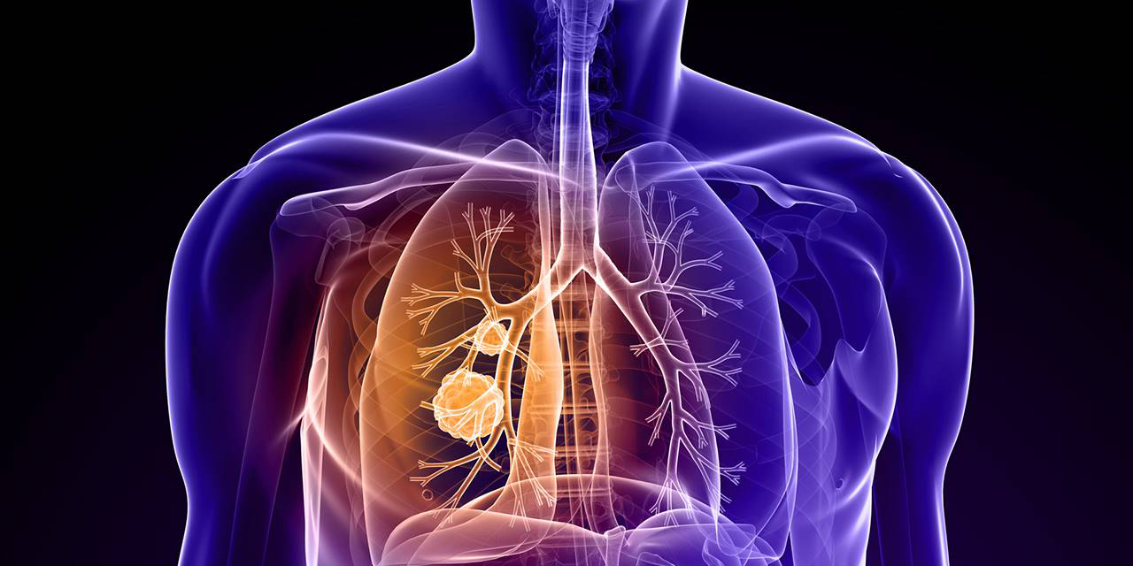 Elevada cifra negra en defunciones asociadas a cáncer de pulmón | El Imparcial de Oaxaca Elevada cifra negra en defunciones asociadas a cáncer de pulmón | El Imparcial de Oaxaca