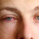 La conjuntivitis, un síntoma de Covid más común con la variante Ómicron