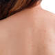 ¡Olvídate del acné en la espalda! Así puedes combatirlo
