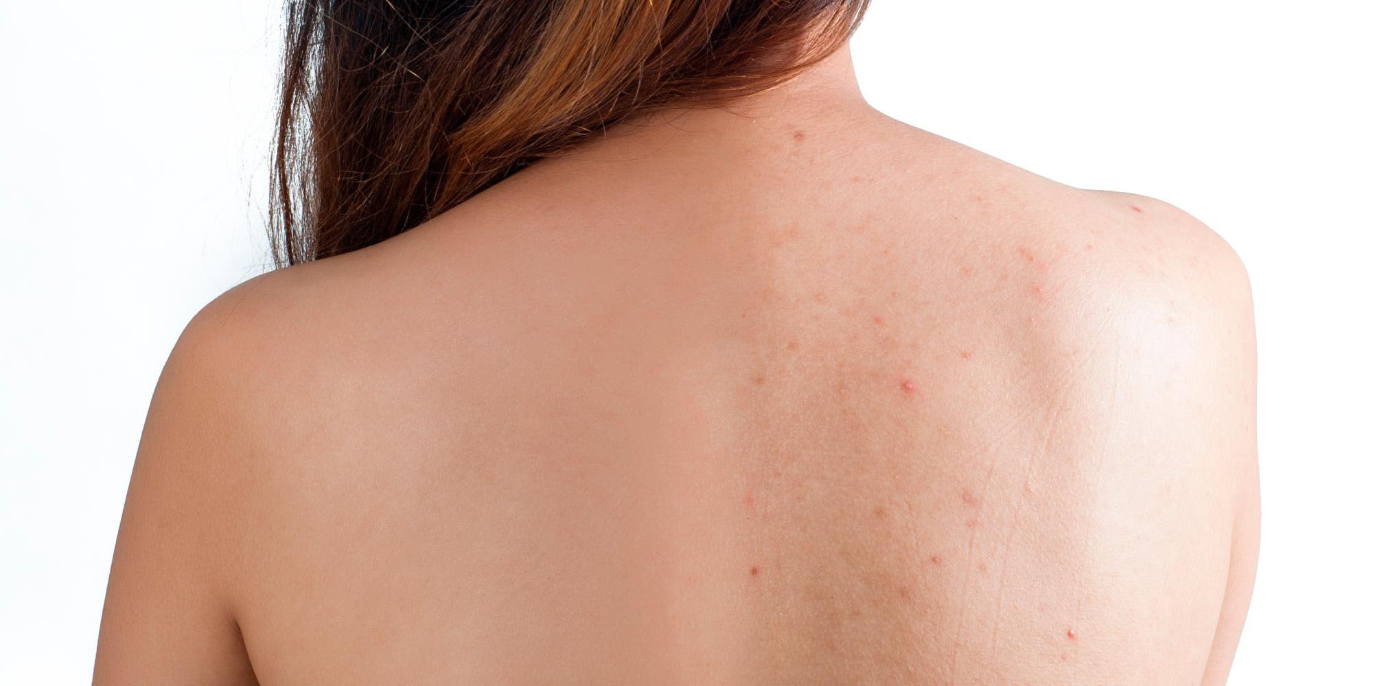 ¡Olvídate del acné en la espalda! Así puedes combatirlo | El Imparcial de Oaxaca