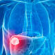 ¿Cuáles son los síntomas de un hígado intoxicado?