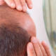 Calvicie: este es el preparado con jengibre para evitar la caída del cabello