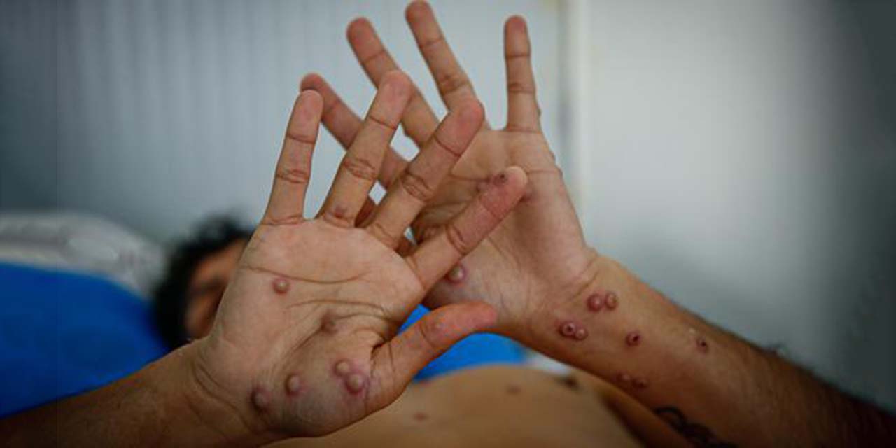 Confirman cuarto caso de viruela símica en Oaxaca | El Imparcial de Oaxaca