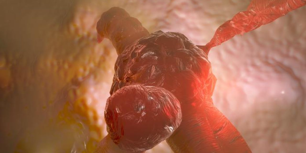 Científicos descubren las células malignas responsables de la recaída en el cáncer de colon | El Imparcial de Oaxaca