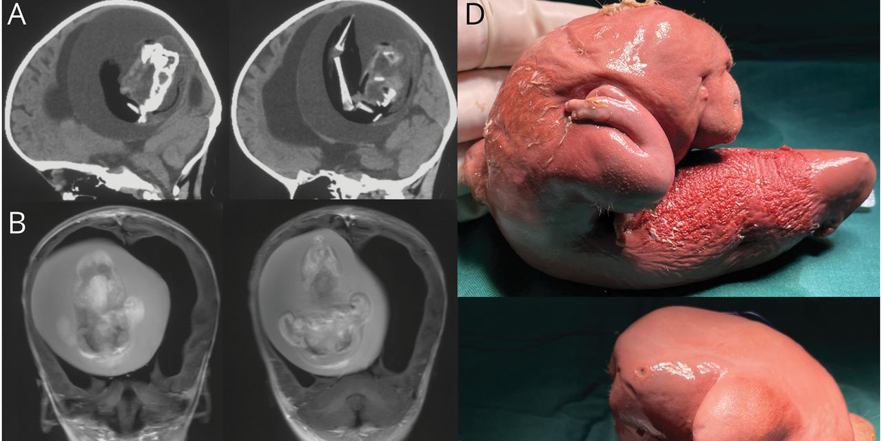 Médicos extraen un feto del cerebro de una niña de un año de edad | El Imparcial de Oaxaca