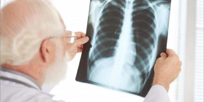 Detectan 8 mil casos nuevos de cáncer de pulmón en México