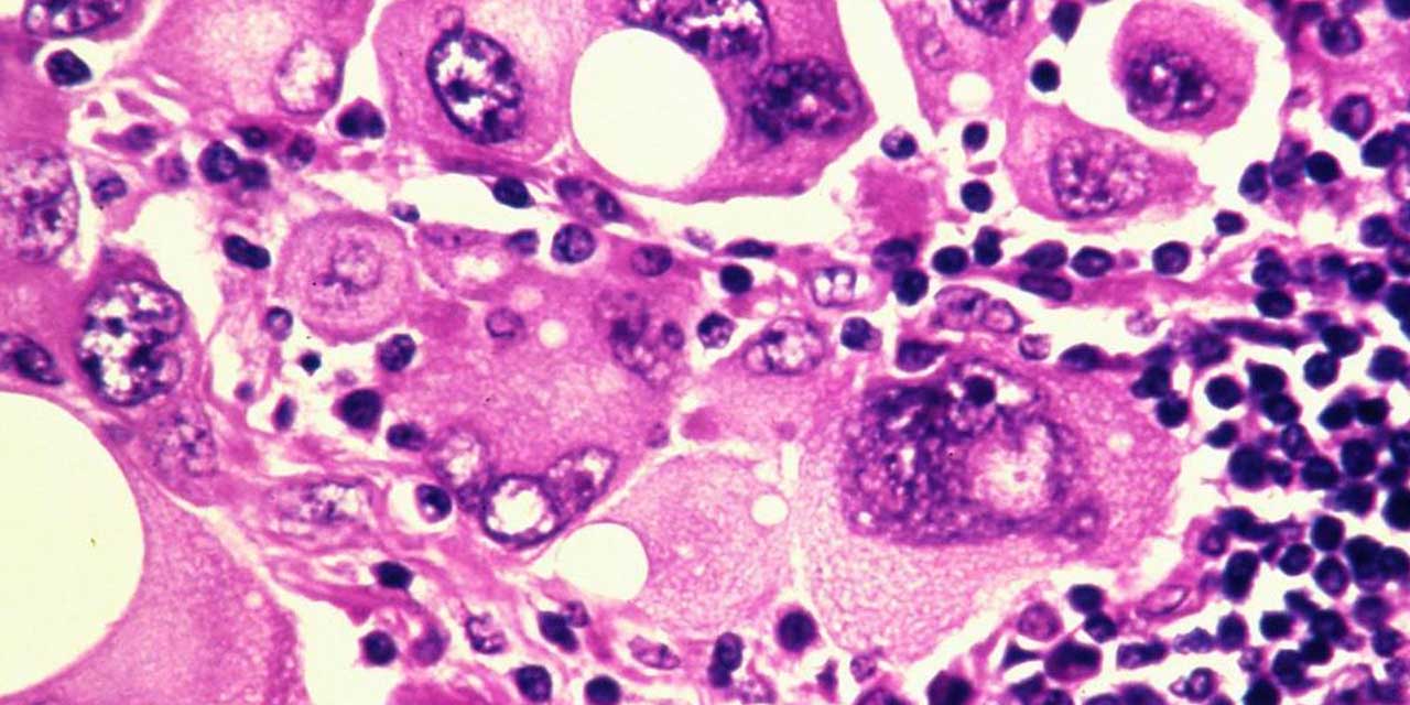La pérdida del cromosoma Y en los hombres aumenta su vulnerabilidad al cáncer