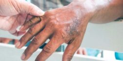 Foto: internet / Confirma sector salud 13 casos de lepra en tratamiento.