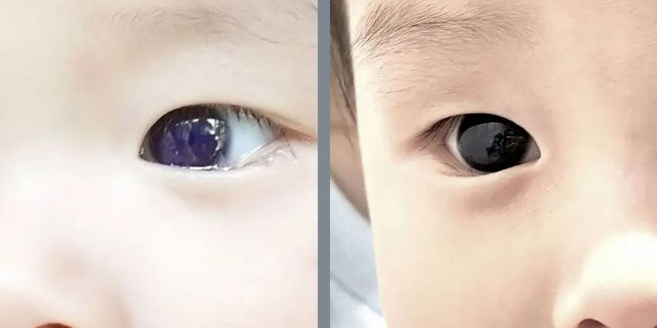 Bebé  cambia temporalmente el color de sus ojos tras tratamiento contra la COVID-19 | El Imparcial de Oaxaca