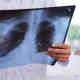 Notifican 20 nuevos casos de tuberculosis