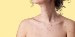 Foto: internet // De los 105 casos de varicela, 49 se han reportado en hombres y 56 en mujeres.