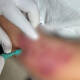 Alarma tras detección de casos de lepra en Pinotepa Nacional