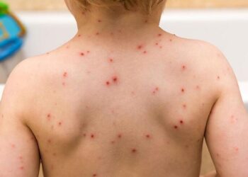 Foto: internet – ilustrativa // La varicela es una enfermedad muy común en la niñez, muy contagiosa, causada por el virus varicela-zoster.
