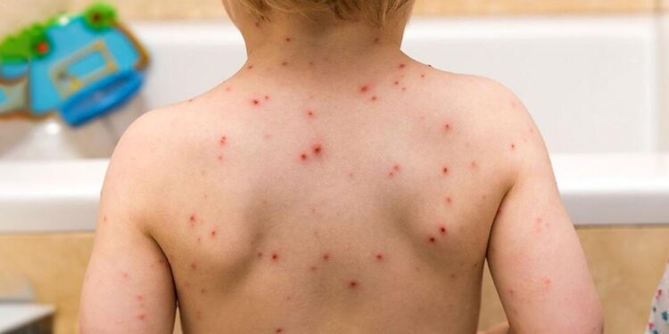 Foto: internet – ilustrativa // La varicela es una enfermedad muy común en la niñez, muy contagiosa, causada por el virus varicela-zoster.