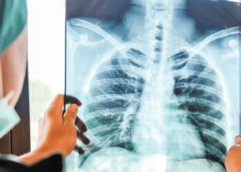Reportan 53 nuevos casos de cáncer de pulmón en 2024