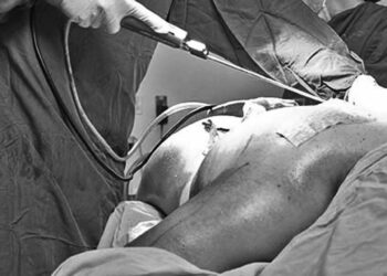 Foto: ilustrativa // Una joven mujer falleció luego de una complicación en el procedimiento de lipoescultura.