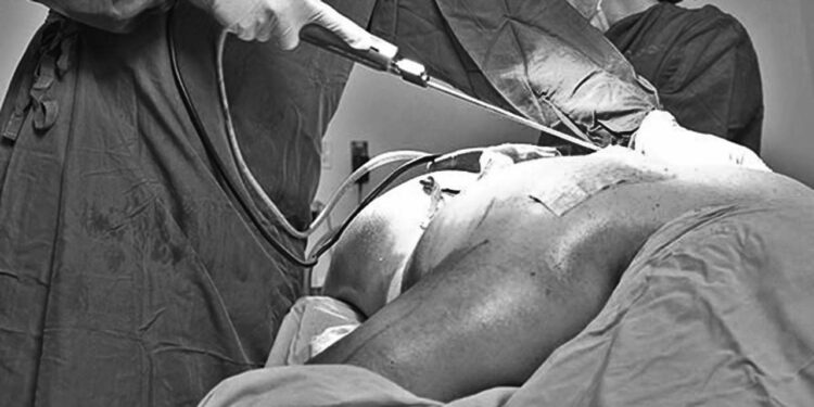 Foto: ilustrativa // Una joven mujer falleció luego de una complicación en el procedimiento de lipoescultura.