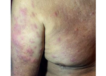Disminuyen casos de lepra en Oaxaca