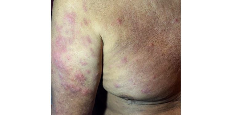 Disminuyen casos de lepra en Oaxaca