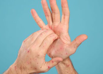 Mpox: ¿Cuáles son sus síntomas y cómo prevenir el contagio?