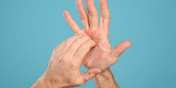 Mpox: ¿Cuáles son sus síntomas y cómo prevenir el contagio?