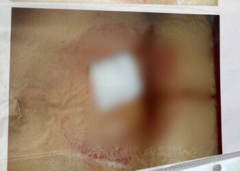 Foto: cortesía // La paciente continúa en tratamientos por las secuelas que le generó una mala intervención quirúrgica.