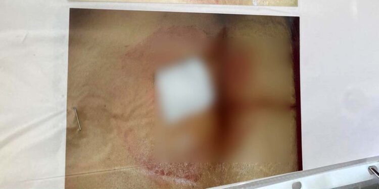 Foto: cortesía // La paciente continúa en tratamientos por las secuelas que le generó una mala intervención quirúrgica.