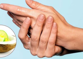 Elimina las pecas de las manos con esta crema casera de limón y coco