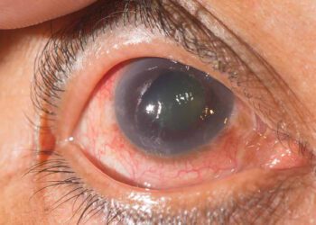 Glaucoma: La enfermedad silenciosa que amenaza la vista de millones de mexicanos