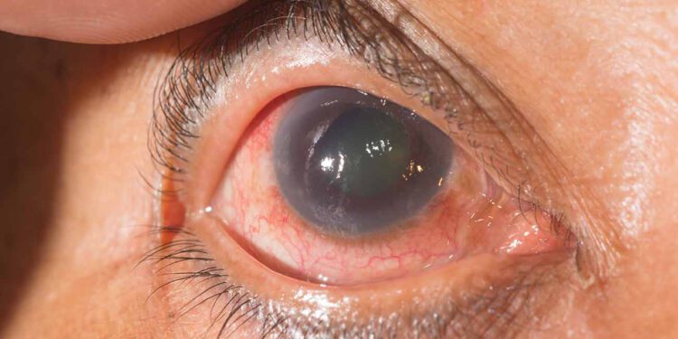 Glaucoma: La enfermedad silenciosa que amenaza la vista de millones de mexicanos