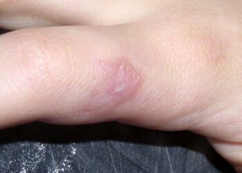 Foto: internet // La enfermedad de “leishmaniasis cutánea” es causada por un parásito transmitido por la picadura de una hembra del mosco Lutzomyia.