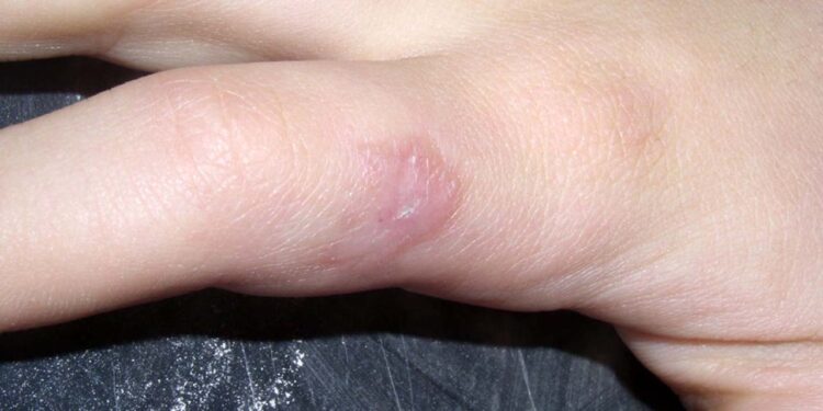 Foto: internet // La enfermedad de “leishmaniasis cutánea” es causada por un parásito transmitido por la picadura de una hembra del mosco Lutzomyia.