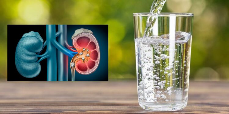 ¿Beber agua mineral puede causar cálculos renales? Esto dicen los expertos sobre sus riesgos y beneficios