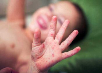Foto: ilustrativa // De esta enfermedad, el sector salud recordó que las señales más comunes son la fiebre, congestión nasal, ojos rojos o irritados, manchas pequeñas dentro de la boca y erupción en la piel.
