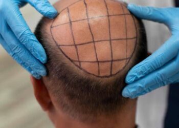 Mejores clínicas de injerto de cabello en México: lo que debes saber antes de elegir