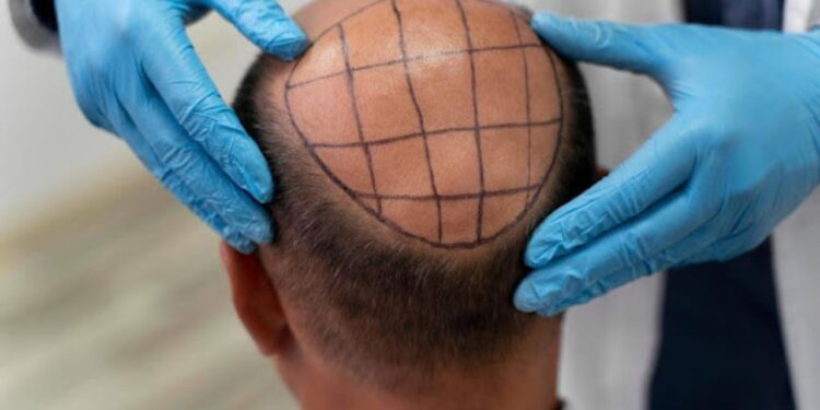 Mejores clínicas de injerto de cabello en México: lo que debes saber antes de elegir