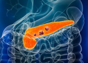 ¿Por qué el cáncer de páncreas es conocido como el “asesino silencioso”? Descubre sus riesgos y síntomas
