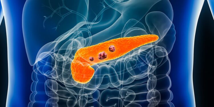 ¿Por qué el cáncer de páncreas es conocido como el “asesino silencioso”? Descubre sus riesgos y síntomas