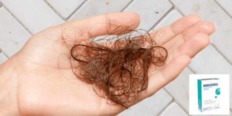 ¿Vale la pena usar minoxidil para la caída del cabello si puede afectar tu salud?