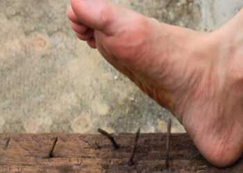 Te enterraste un clavo: ¿Tétanos? Qué hacer paso a paso para evitar complicaciones