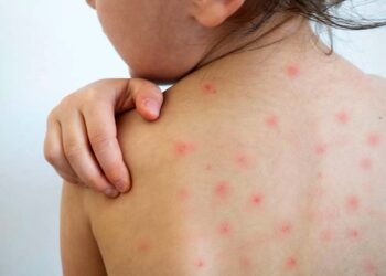 Foto: ilustrativa // La OMS reportó al corte de la Semana Epidemiológica 23 de 2025 un acumulado de 188 mil 355 casos sospechosos y 88 mil 853 casos confirmados a nivel mundial.