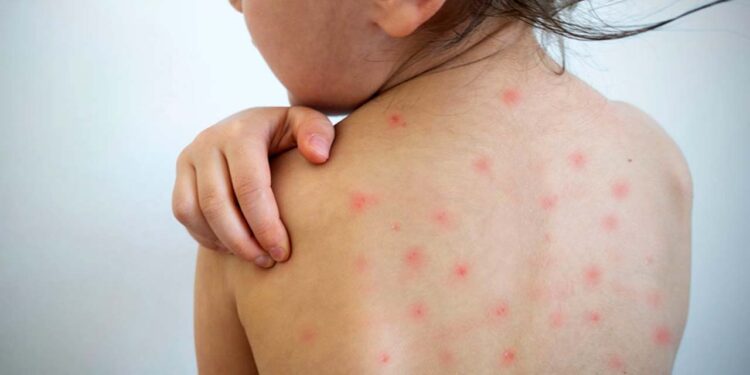Foto: ilustrativa // La OMS reportó al corte de la Semana Epidemiológica 23 de 2025 un acumulado de 188 mil 355 casos sospechosos y 88 mil 853 casos confirmados a nivel mundial.