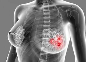 Foto: internet – ilustrativa // Los casos de atención por tumor maligno de la mama presentan un aumento en este 2025 con 409 casos a la fecha, superior a los 402 de 2024 en el mismo periodo.