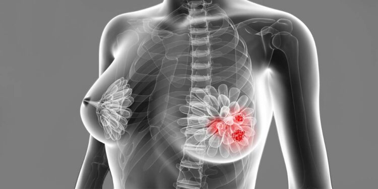 Foto: internet – ilustrativa // Los casos de atención por tumor maligno de la mama presentan un aumento en este 2025 con 409 casos a la fecha, superior a los 402 de 2024 en el mismo periodo.