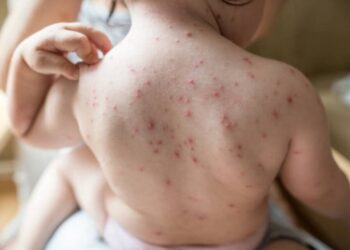 México, segunda cifra más alta de sarampión en AL