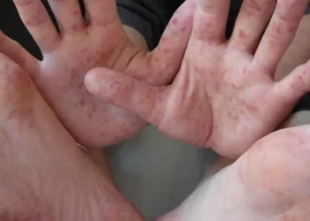 El sector salud exhortó a mantener medidas de higiene estrictas para reducir el riesgo de contagio de esta enfermedad.