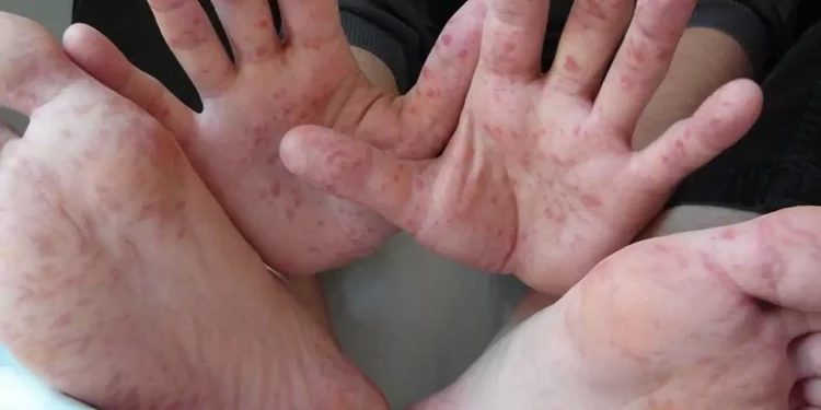 El sector salud exhortó a mantener medidas de higiene estrictas para reducir el riesgo de contagio de esta enfermedad.