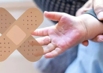 ¿Cómo tratar una quemadura de segundo grado en niños?